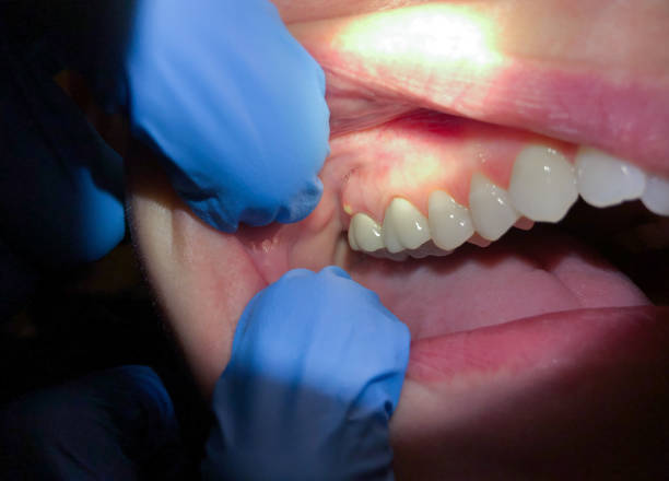 Best Broken or Chipped Tooth Repair in Temelec, CA